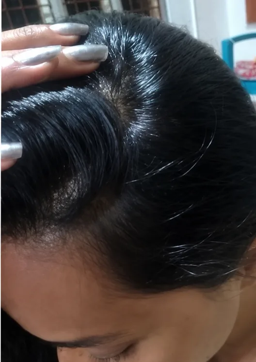Hair Density & Hair Fall Reversal — after