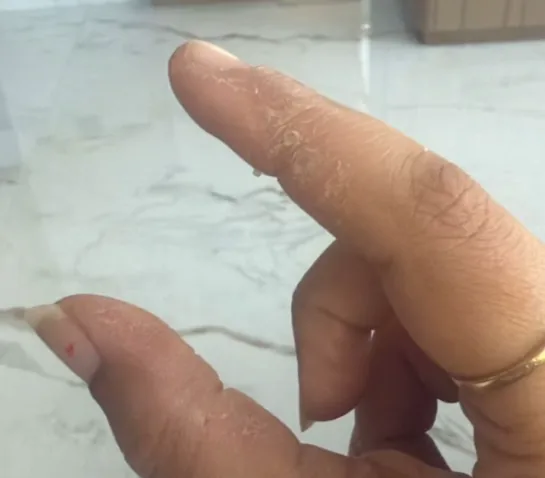 Skin Barrier & Peeling Recovery — before