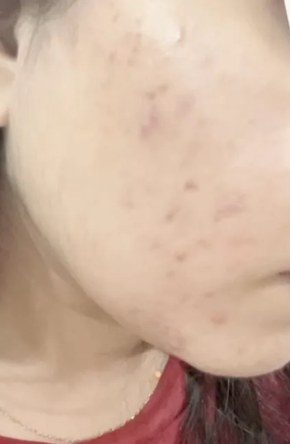 Hormonal Acne & Clear Skin Journey — after