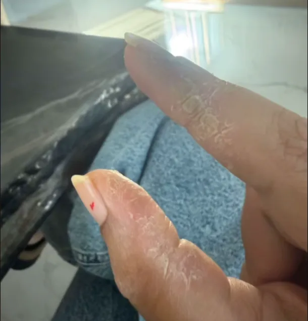 Skin Barrier & Peeling Recovery — after
