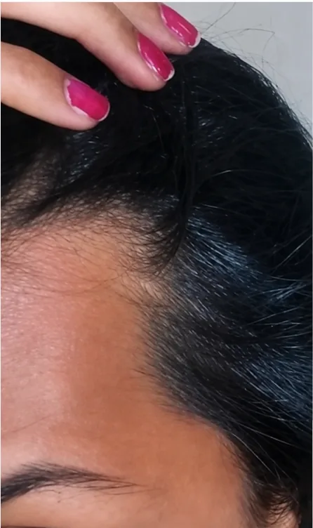 Hair Density & Hair Fall Reversal — before