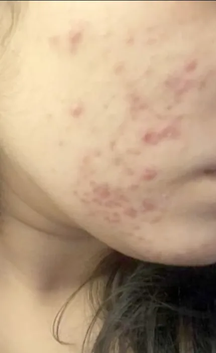 Hormonal Acne & Clear Skin Journey — before